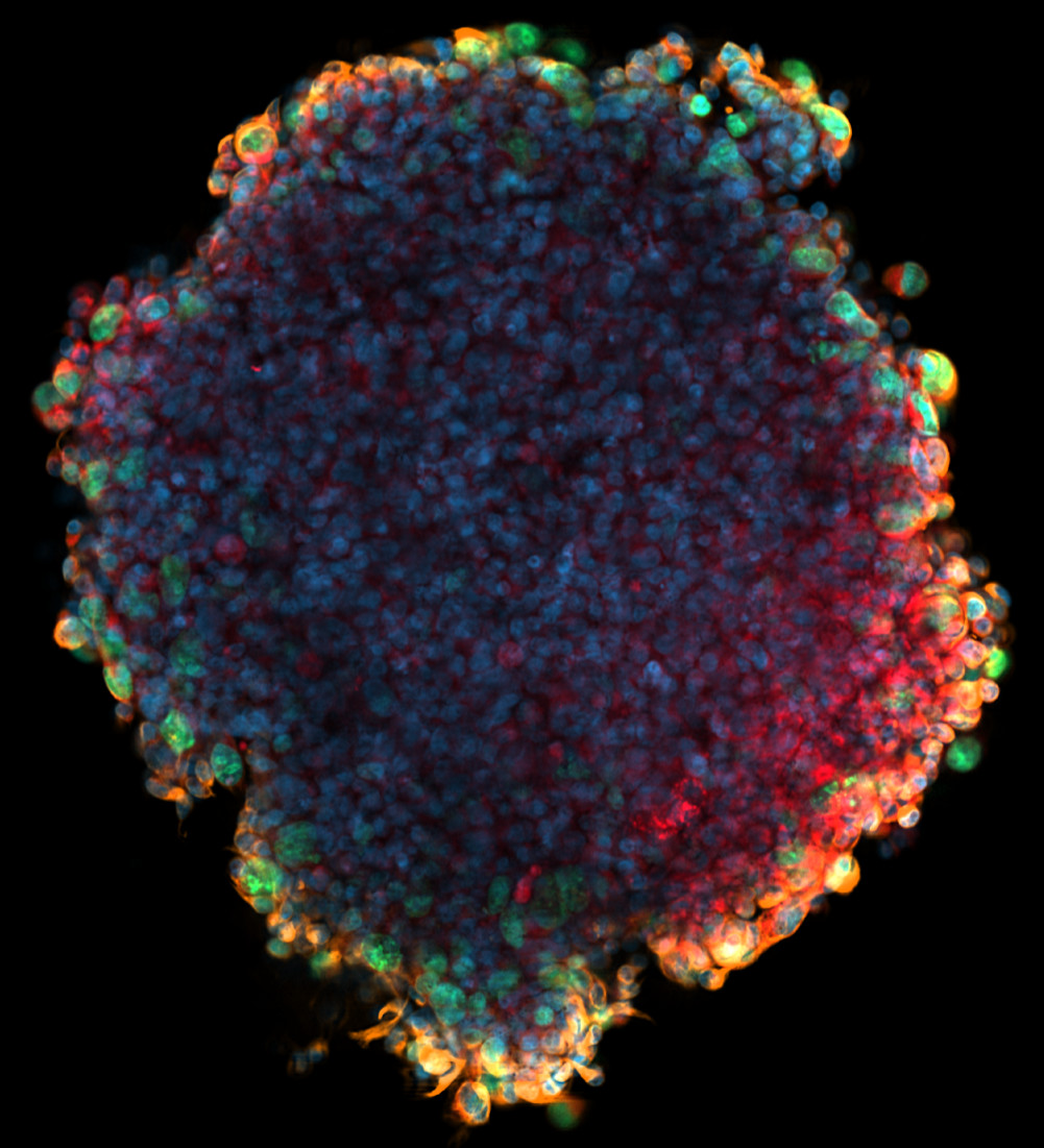 Fluorescence microscopy of tumor spheroid